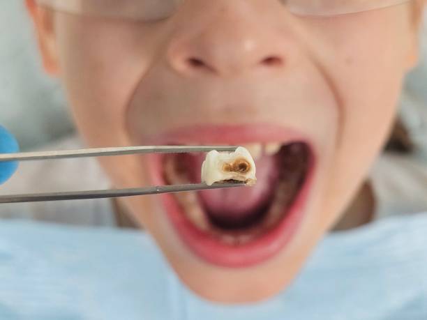 Best Emergency Broken Tooth Repair in Anaheim, CA